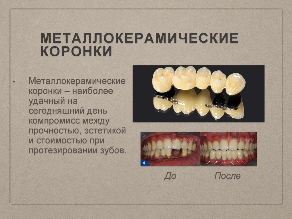 Металлокерамические коронки для зубов и их минусы: фото протезов от Dominanta74